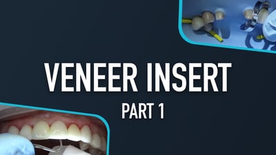 Veneer Insert - Part 1