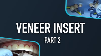 Veneer Insert - Part 2