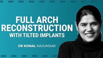 Full Arch Reconstructions with Tilted Implants