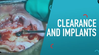 Clearance and Implants