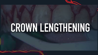 Crown Lengthening