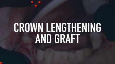 Crown Lengthening and Graft