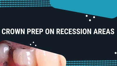 Crown Prep on Recession Areas