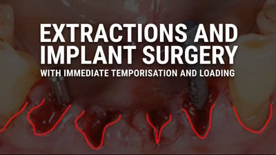 Extractions and Implant Surgery