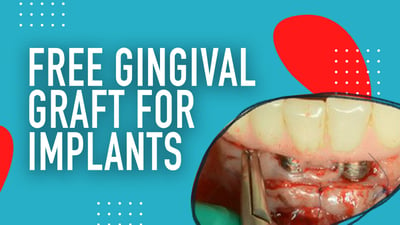Free Gingival Graft for Implants