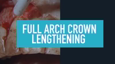 Full Arch Crown Lengthening