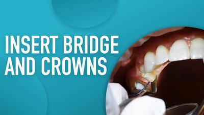 Insert Bridge and Crowns