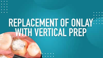 Replacement of Onlay with Vertical Prep